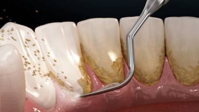 Dental Plaque