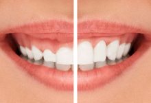 gingivectomy before and after