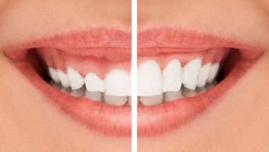 gingivectomy before and after